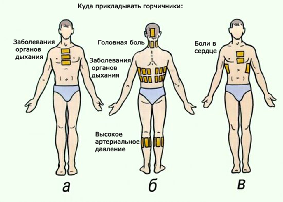 Схема постановки горчичников при бронхите