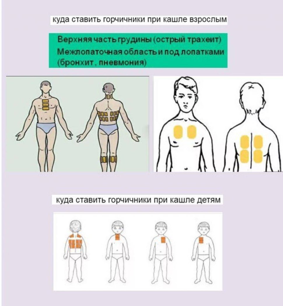 Горчичники схема наложения